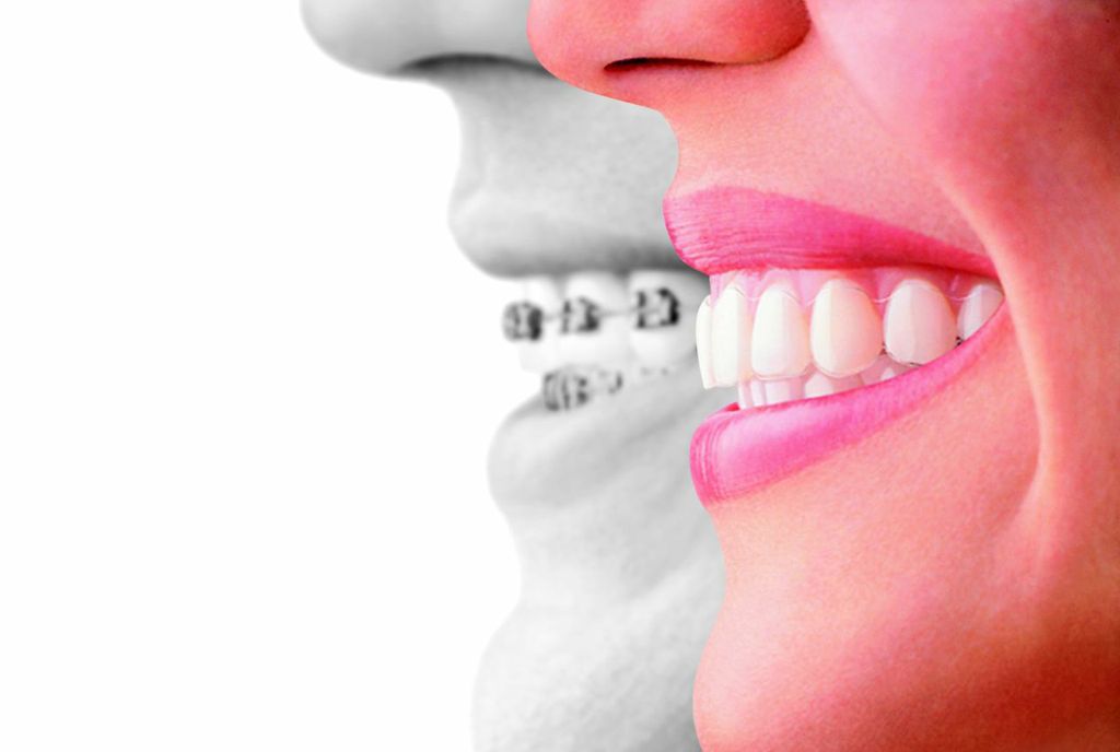 Invisalign, proven effective to replace braces